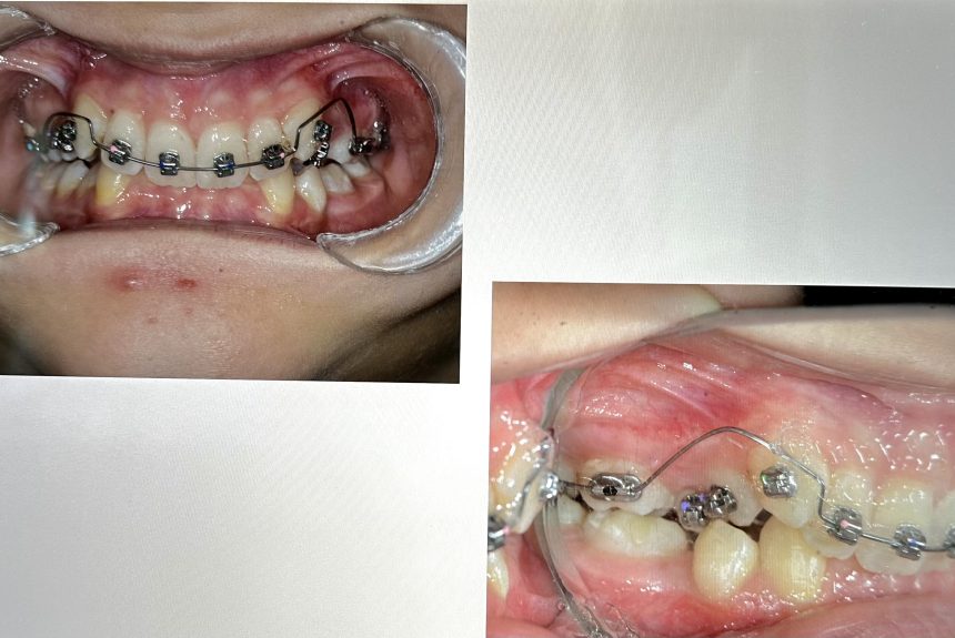 intrüzyon Ortodontide İntrüzyon